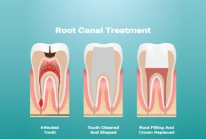 Root Canal Treatment in Thomson