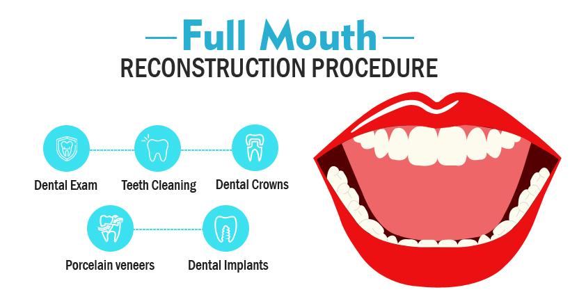 Full Mouth Rehabilitation in Thonson Singapore