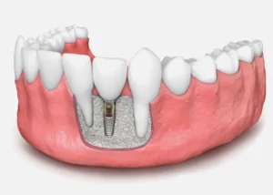 bone grafting in Thomson, Singapore