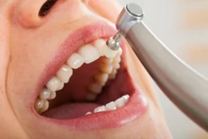 fluoride treatment in Thomson