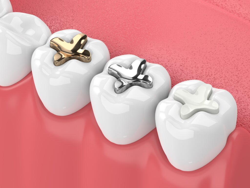 dental fillings in thomson