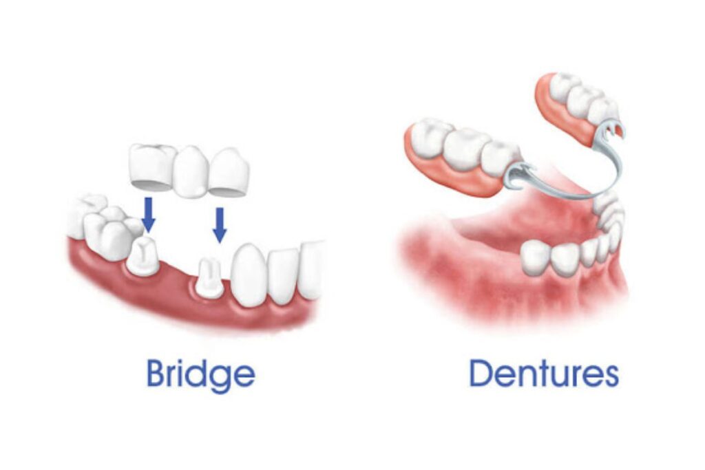 Dental Bridge vs. Partial Denture in Thomson