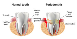 Periodontal and Gum Treatment in Thomson