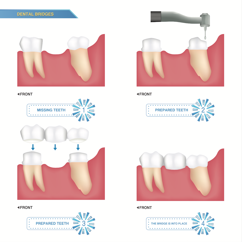 Preparing for a Dental Bridge in Thomson