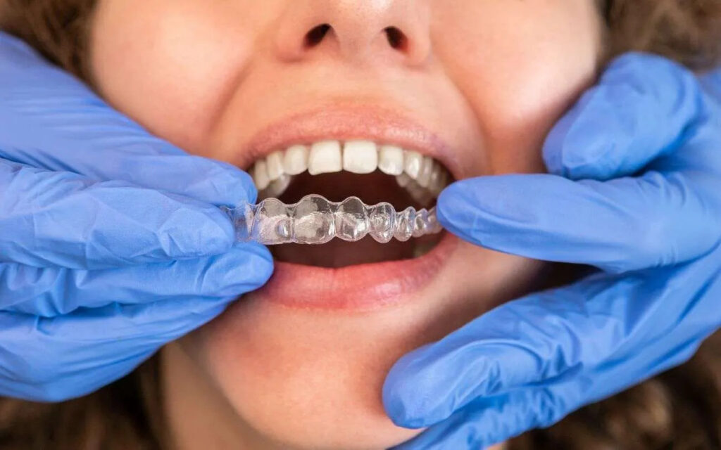 The Role of Bite Alignment in Thomson