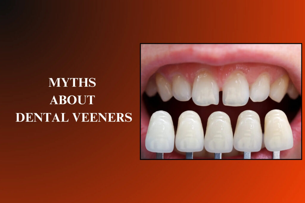 Common Myths About Dental Veneers – Debunked by Dentists