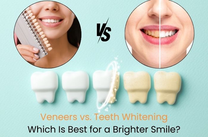 Porcelain Veneers vs. Teeth Whitening in Thomson ,Singapore
